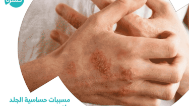 مسببات حساسية الجلد وأفضل مرهم للحساسيه وعلاجها طبيعياً